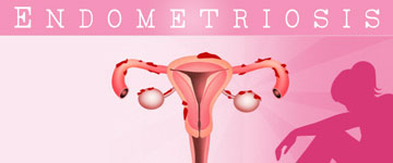 Eindelijk weten we iets meer: ik heb endometriose