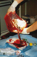 moederkoek placenta