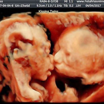 tweeling foetus spelen