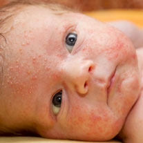acne baby