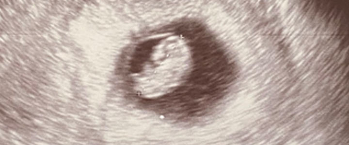 Peuter mama met Diabetes type 1 en zwanger - deel 3 Peuter mama met Diabetes type 1 en zwanger - deel 3