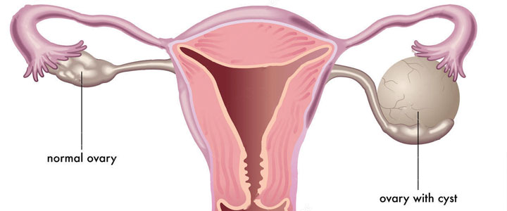 Kan je zwanger worden met een cyste bij je eierstok? | ikbenZwanger