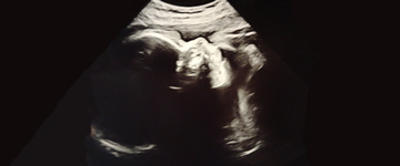 Hoge vliesscheur met 30 weken - Zal onze zoon te vroeg geboren worden?