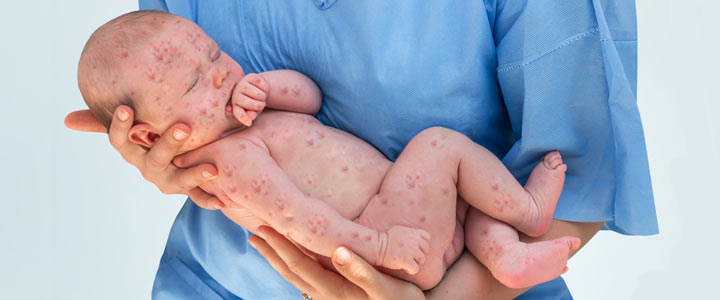 Vlekjesziekten bij je baby Vlekjesziekten bij je baby